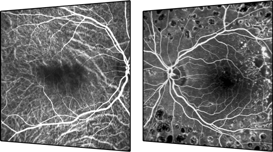 Scanning Laser Angiography